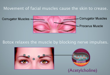 slides_botox_howitworks