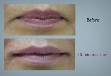 slides_fillers_lips