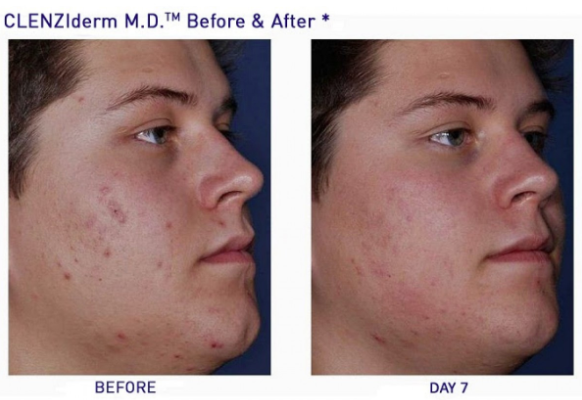 acne adult onset acne adult onset