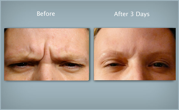 slides_botox_howitworks