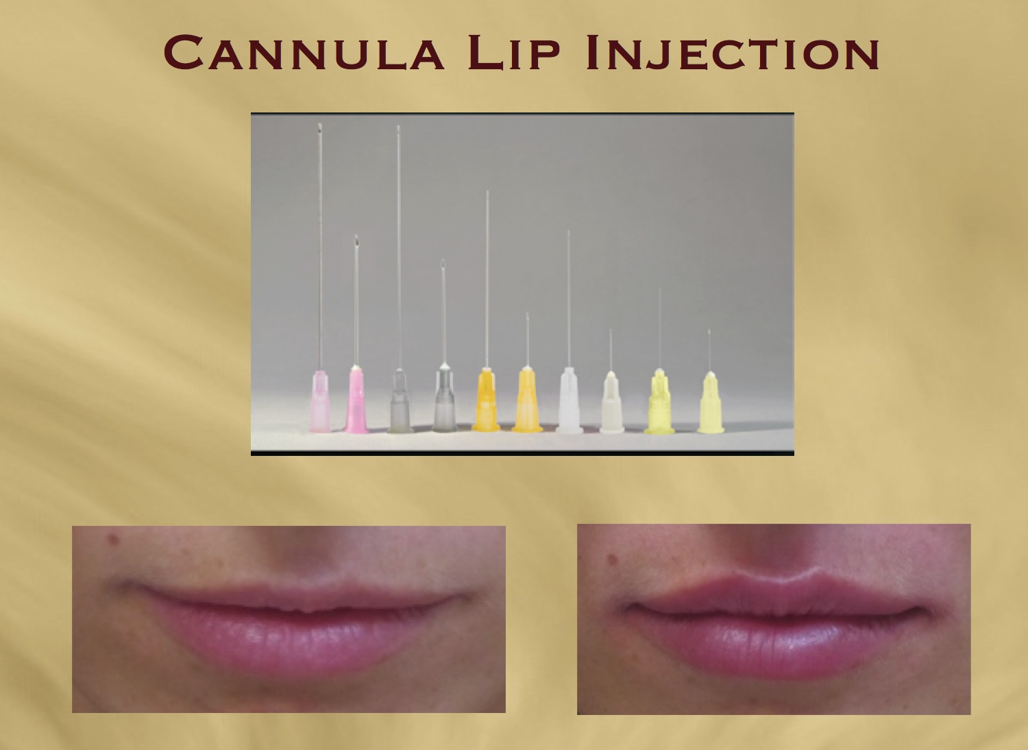 "Lip Cannula Injection is the best technique for lip fillers" Dr