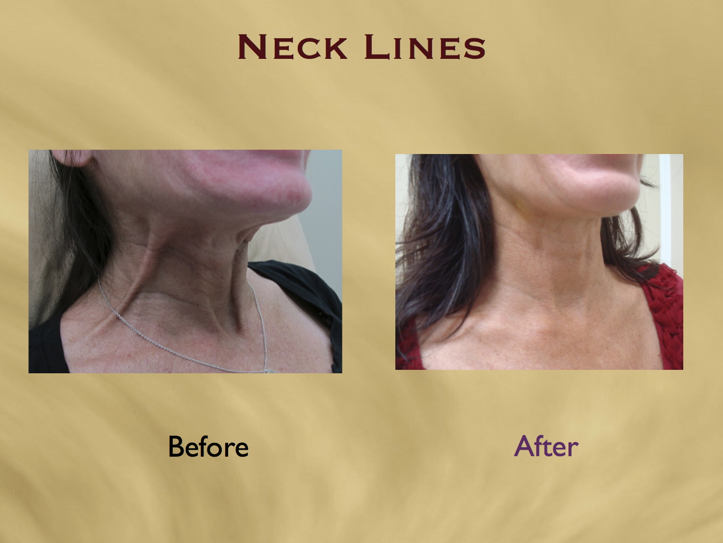 Nefertiti Lift And Neck Wrinkle Smoothing With Botox Aesthetics Hawaii 