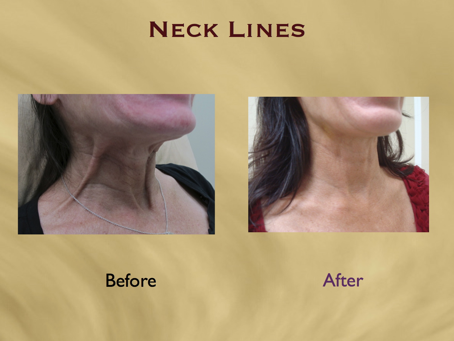 Nefertiti Lift and Neck Wrinkle Smoothing with Botox Aesthetics Hawaii