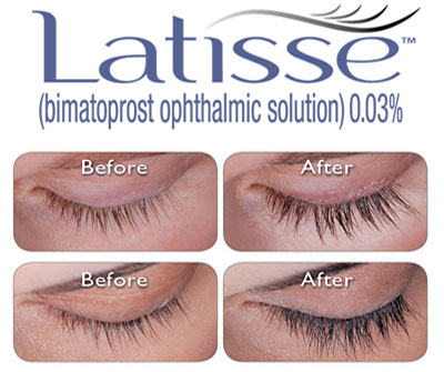 latisse-brooke-shields 03-44-15 Get $100 Rebate when you buy Latisse & get treated with Botox!